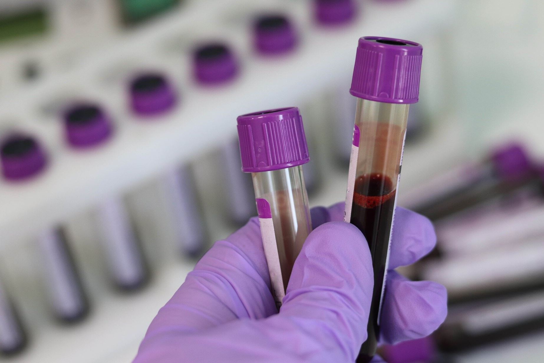 medical-technology-news-new-blood-test-for-ovarian-cancer