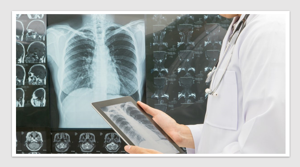 AI partnership to propel launch of National Lung Cancer Screening Programme